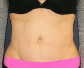 Feel Beautiful - Tummy-Tuck-Scar - After Photo